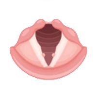 성대결절